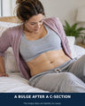 C-Section Recovery: Why Does Your Stomach Still Bulge in the Middle?