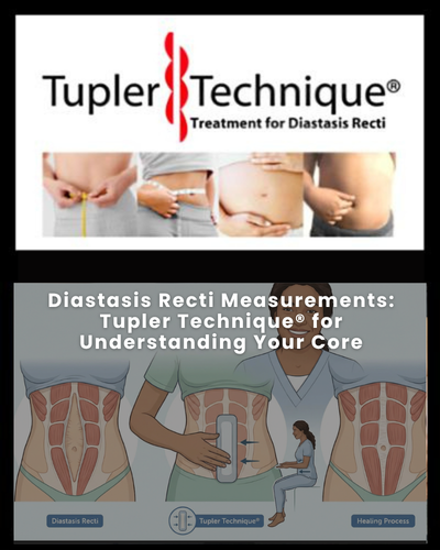 Diastasis Recti Measurements: Tupler Technique® for Understanding Your Core