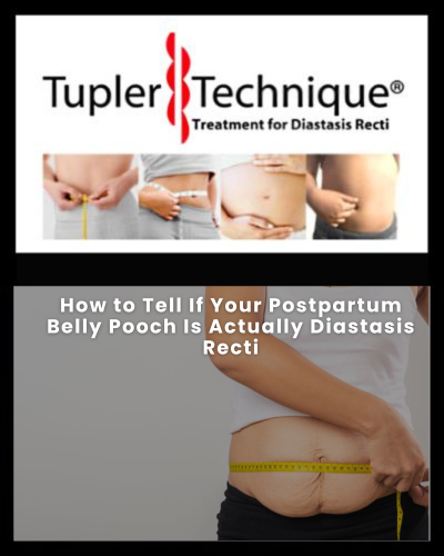 How to Tell If Your Postpartum Belly Pooch Is Actually Diastasis Recti