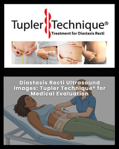 Diastasis Recti Ultrasound Images: Tupler Technique® for Medical Evaluation