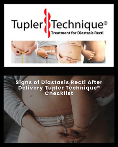 Signs of Diastasis Recti After Delivery Tupler Technique® Checklist