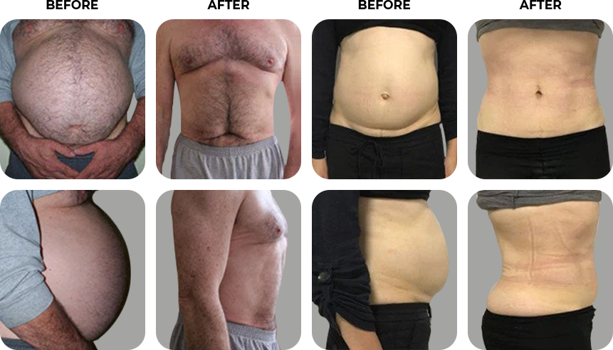 before_after_belly_img