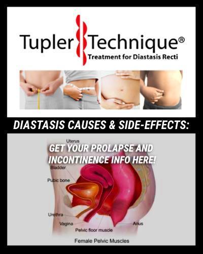 DIASTASIS CAUSES & SIDE-EFFECTS: Get Your Prolapse and Incontinence Info Here! - diastasisrehab