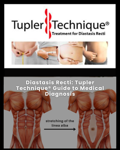 Diastasis Recti: Tupler Technique® Guide to Medical Diagnosis