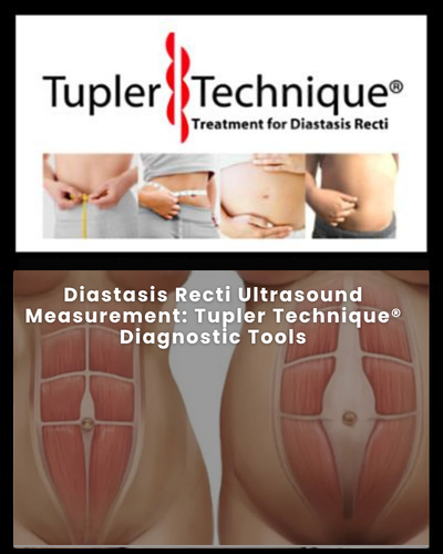 Diastasis Recti Ultrasound Measurement: Tupler Technique® Diagnostic Tools