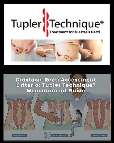 Diastasis Recti Assessment Criteria: Tupler Technique® Measurement Guide