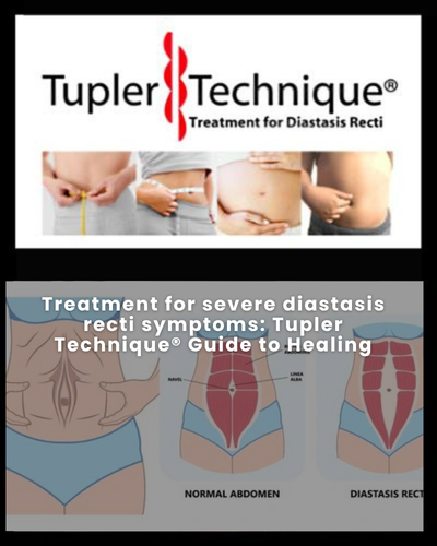 Treatment for severe diastasis recti symptoms: Tupler Technique® Guide to Healing