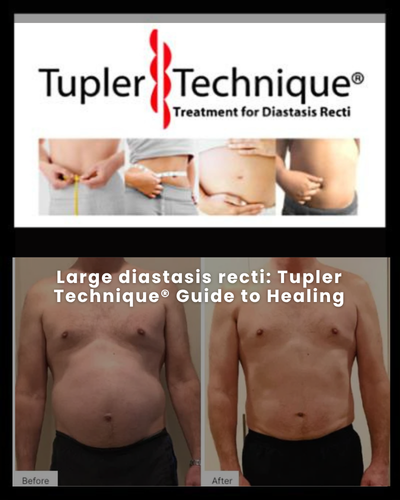 Large diastasis recti: Tupler Technique® Guide to Healing