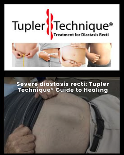 Severe diastasis recti: Tupler Technique® Guide to Healing