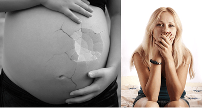5 Little-Known Facts About Rectus Diastasis Recovery! - diastasisrehab