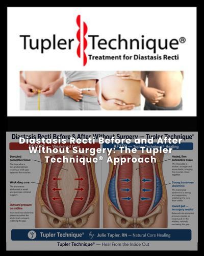 Diastasis Recti Before and After Without Surgery: The Tupler Technique® Approach