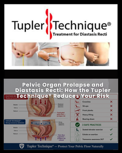 Pelvic Organ Prolapse and Diastasis Recti: How the Tupler Technique® Reduces Your Risk
