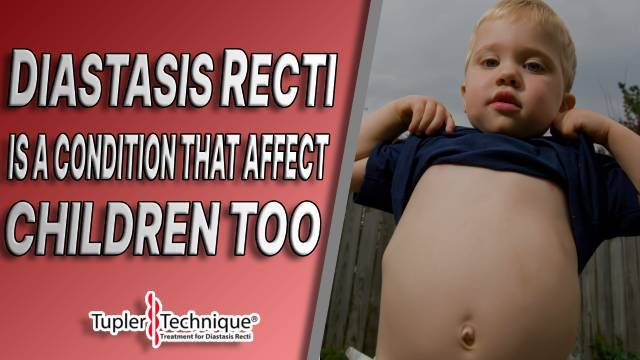 DIASTASIS RECTI: A CONDITION THAT AFFECT CHILDREN TOO