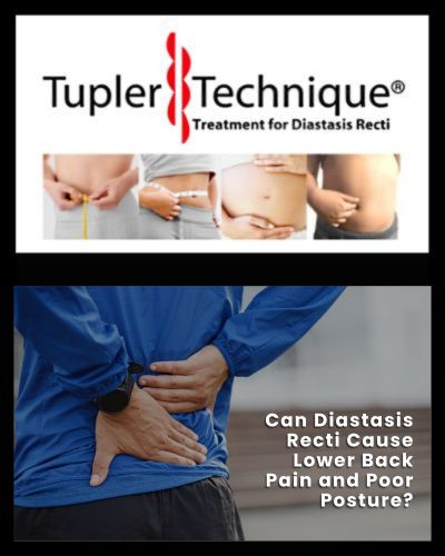 Can Diastasis Recti Cause Lower Back Pain and Poor Posture?