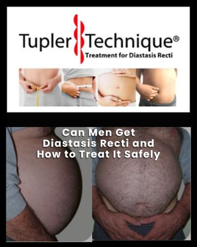 Can Men Get Diastasis Recti and How to Treat It Safely
