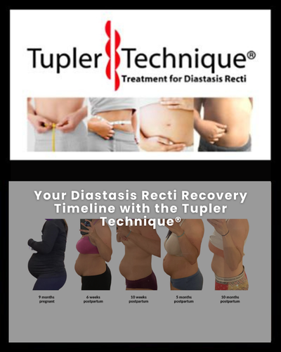 Your Diastasis Recti Recovery Timeline with the Tupler Technique - Diastasis Rehab