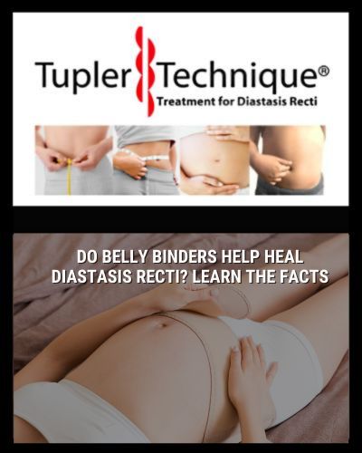 Do Belly Binders Help Heal Diastasis Recti? Learn the Facts