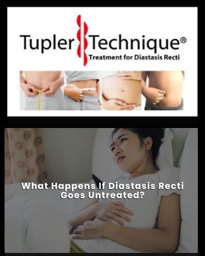What Happens If Diastasis Recti Goes Untreated - Diastasis Rehab