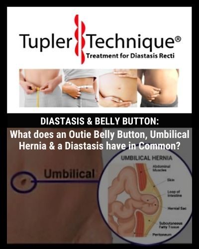 Unraveling the Link: Outie Belly Button, Umbilical Hernia & Diastasis Recti Explained