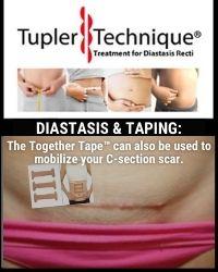 The Together Tape™ can also be used to mobilize your C-section scar.