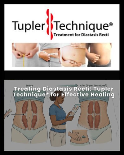 Treating Diastasis Recti: Tupler Technique® for Effective Healing