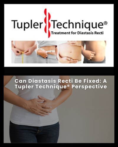 Can Diastasis Recti Be Fixed: A Tupler Technique® Perspective
