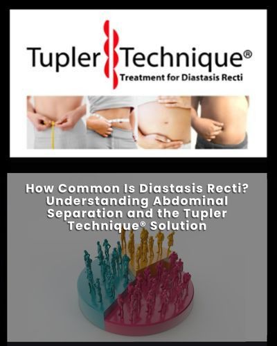 How Common Is Diastasis Recti? Understanding Abdominal Separation and the Tupler Technique® Solution