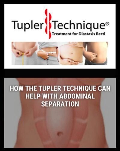 How the Tupler Technique® Can Help with Abdominal Separation poster