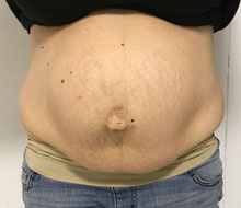 Belly Bulging Out of the Bottom Splint - Diastasis Rehab