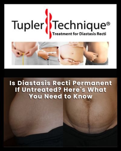 Is Diastasis Recti Permanent If Untreated? Here's What You Need to Know