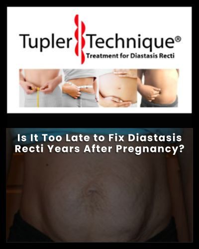 Is It Too Late to Fix Diastasis Recti Years After Pregnancy?