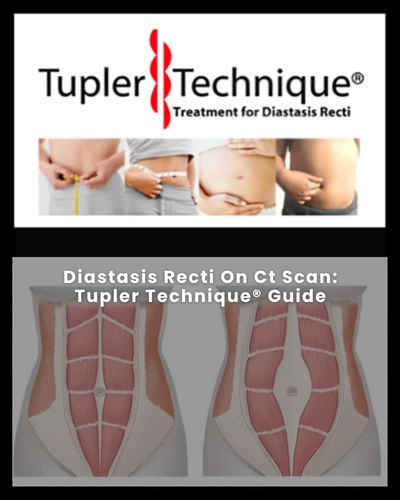 Diastasis Recti On Ct Scan: Tupler Technique® Guide