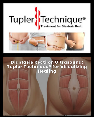 Diastasis Recti on Ultrasound: Tupler Technique® for Visualizing Healing