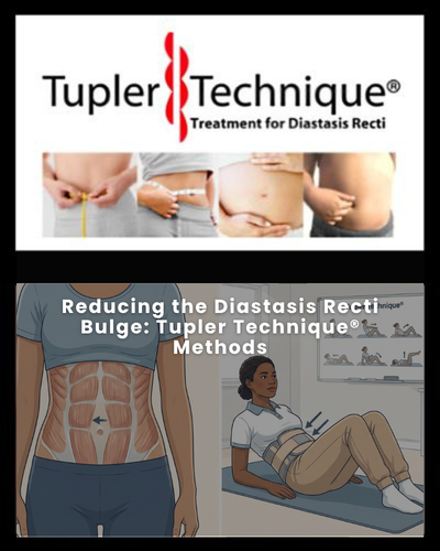Reducing the Diastasis Recti Bulge: Tupler Technique® Methods