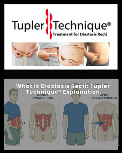 What is Diastasis Recti: Tupler Technique® Explanation