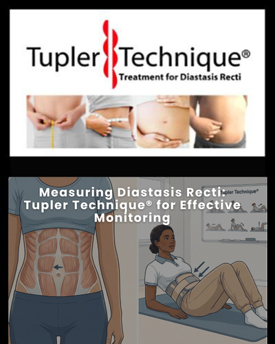 Measuring Diastasis Recti: Tupler Technique® for Effective Monitoring