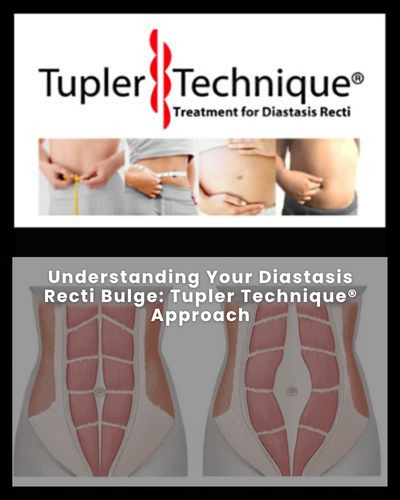 Understanding Your Diastasis Recti Bulge: Tupler Technique® Approach