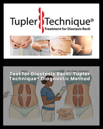 Test for Diastasis Recti: Tupler Technique® Diagnostic Method