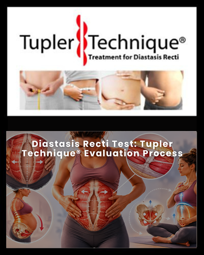 Diastasis Recti Test: Tupler Technique® Evaluation Process