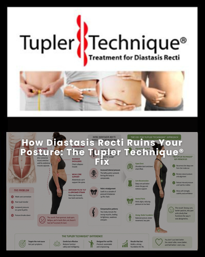 How Diastasis Recti Ruins Your Posture: The Tupler Technique® Fix