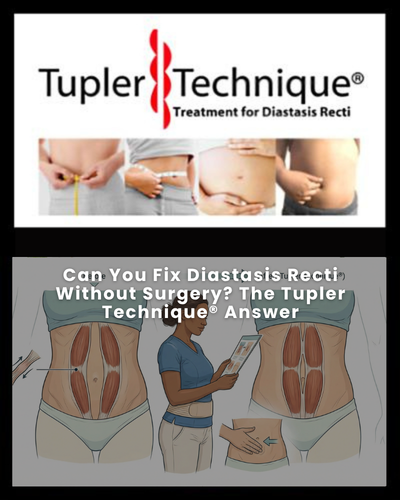 Can You Fix Diastasis Recti Without Surgery? The Tupler Technique® Answer