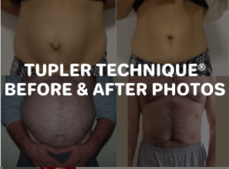 Tupler Technique Before & After Photos - Diastasis Rehab