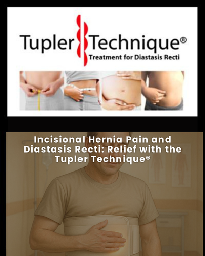 Tupler Technique for Pain Relief: Hernia & Diastasis Recti – diastasisrehab