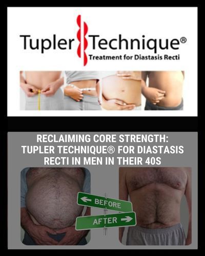 Reclaiming Core Strength: Tupler Technique® for Diastasis Recti Exercises For in Men in Their 40s