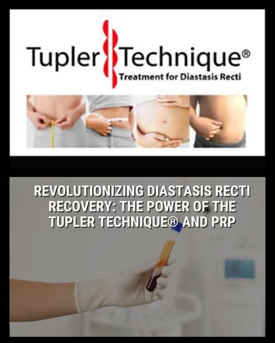 Revolutionizing Diastasis Recti Recovery: The Power of the Tupler Technique® and PRP