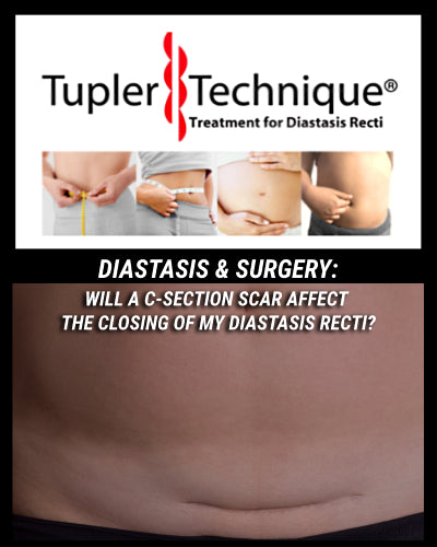 Discover How a C-Section Scar Impacts Diastasis Recti Healing