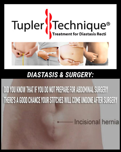 The Shocking Truth About Surgery for Diastasis Recti!