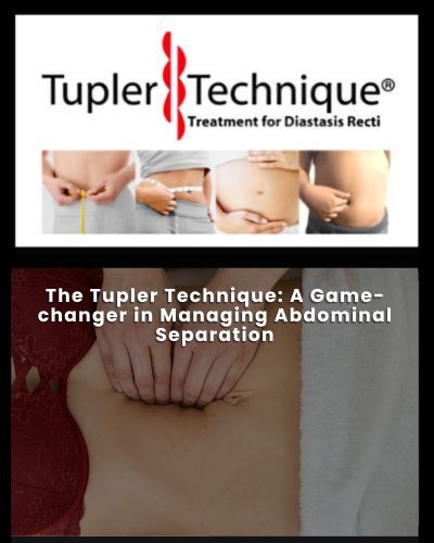 Tupler Technique: A Game-changer in Managing Abdominal Separation - Diastasis Rehab