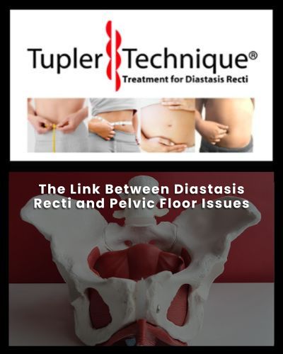 The Link Between Diastasis Recti and Pelvic Floor Issues