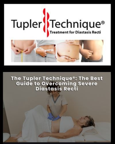 The Tupler Technique®: The Best Guide to Overcoming Severe Diastasis Recti